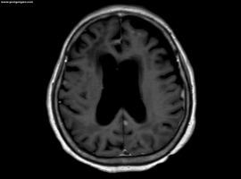 L861Q多发脑转和脑膜转使用佐利替尼联合双倍剂量奥希替尼后效果不佳，求后续方案